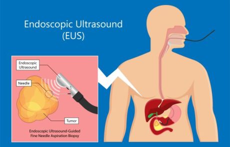 בדיקת EUS: למה היא חשובה ומה היתרונות שלה?